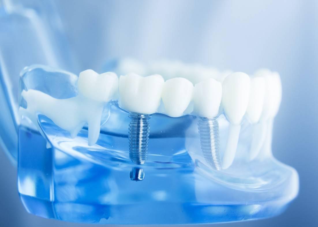 Dental Implants Cerritos, CA