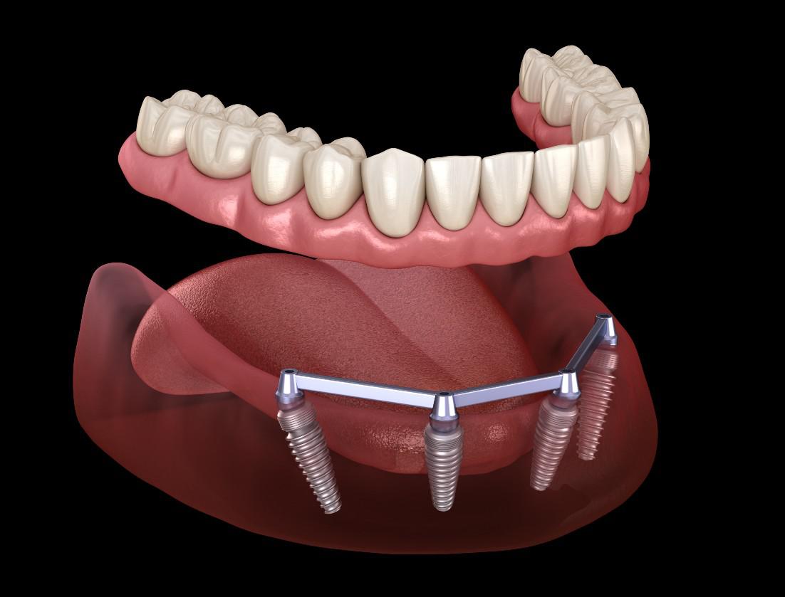 Dentures Cerritos CA