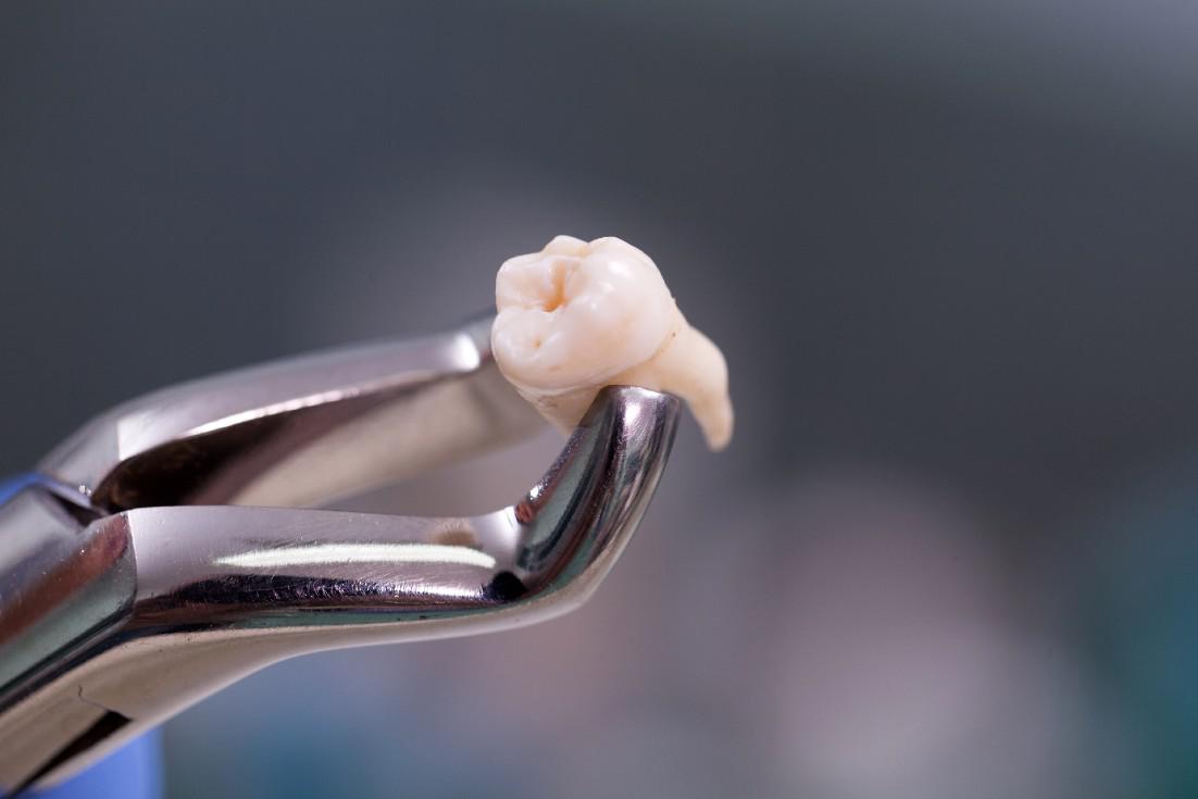 Wisdom Teeth Removal Cerritos, CA